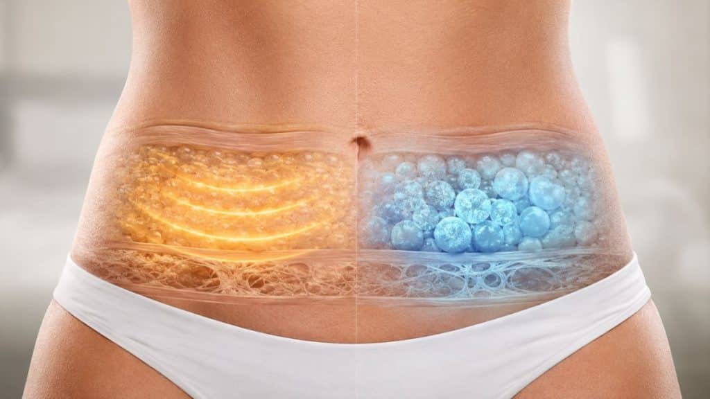 Onda Pro vs Coolsculpting Apa Bedanya dan Mana yang Lebih Sesuai
