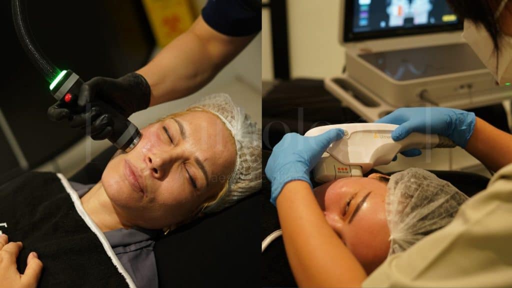Onda Pro vs Ultherapy Prime Apa Bedanya dan Mana yang Lebih Sesuai