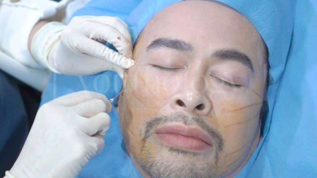 Berapa Lama Hasil Thread Lift Bertahan