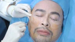 Berapa Lama Hasil Thread Lift Bertahan