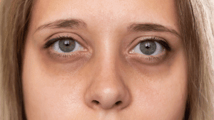PolyPhil Eye: Solusi Medis Atasi Mata Panda, Garis Halus, dan Kulit Bawah Mata yang Menipis