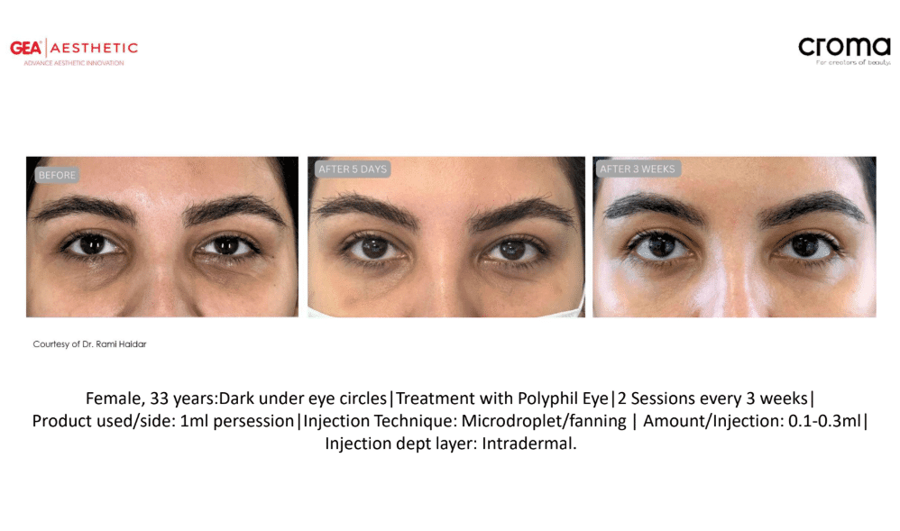 PolyPhil eye Before After